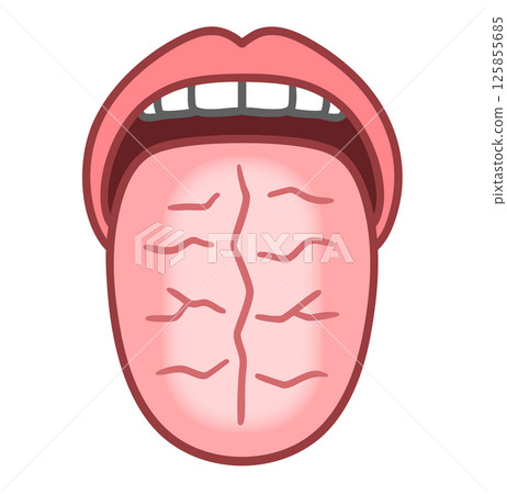 Illustration of a cracked tongue, tongue diagnosis, and diseased tongue Illustration of a cracked tongue, tongue diagnosis, and diseased tongue 125855685