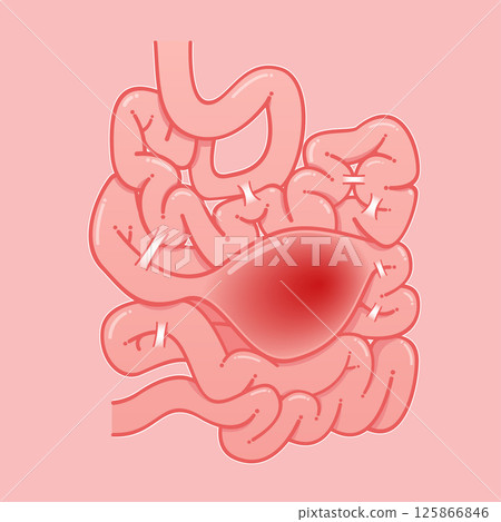 An illustration of the intestines exhibiting signs of constipation. An illustration of the intestines exhibiting signs of constipation. 125866846