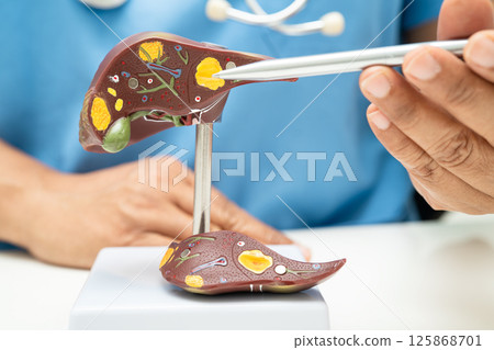 Cirrhosis, Liver cancer, fatty liver, Asian doctor with liver human anatomy model in World Hepatitis Day at hospital. 125868701