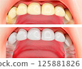 Patient before and after professional teeth whitening treatment. 3D illustration 125881826
