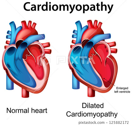 Comparison of Normal Heart and Dilated Cardiomyopathy 125882172