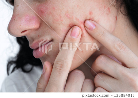 young woman presses acne and pimples on the skin on face with fingers. Girl with problematic skin close-up on white background 125884015