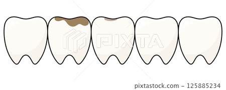 Vector illustration set of tooth with decay Vector illustration set of tooth with decay 125885234