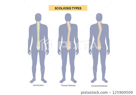 Scoliosis medical poster Scoliosis medical poster 125909509
