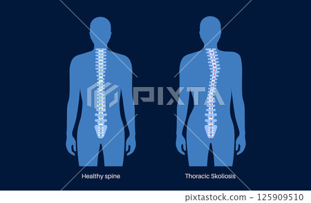Scoliosis medical poster 125909510
