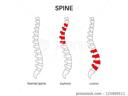 Scoliosis medical poster 125909511