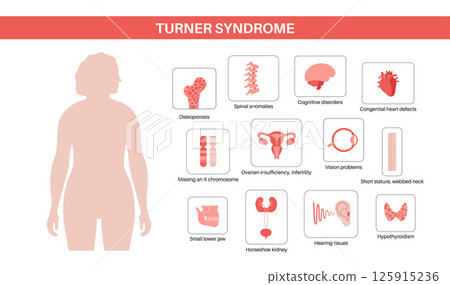 Turner syndrome poster 125915236