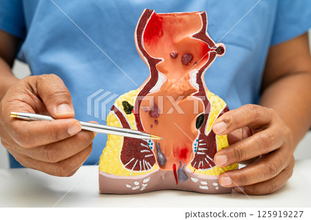 Asian doctor with rectum and hemorrhoid human anatomy model at hospital, inflamed vascular structure. Asian doctor with rectum and hemorrhoid human anatomy model at hospital, inflamed vascular structure. 125919227