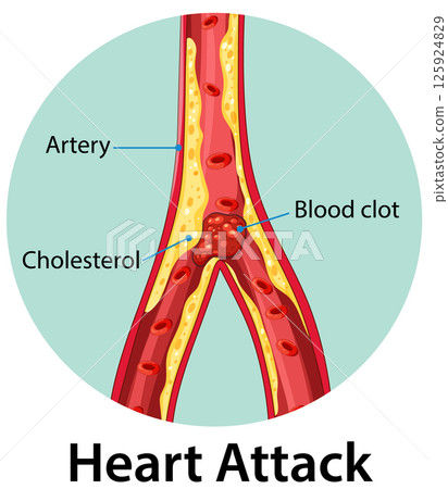Heart Attack Illustration with Artery and Blood Clot 125924829