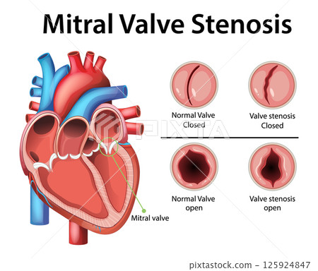 Mitral Valve Stenosis Medical Illustration 125924847