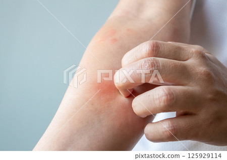 Young asian man itching and scratching on arm from allergic itchy dry skin eczema dermatitis insect bites 125929114