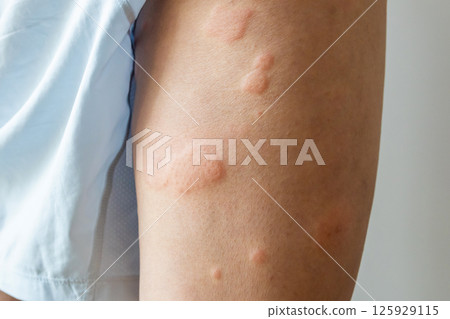 Young asian man has allergic skin rash on his legs from itchy dry skin eczema dermatitis insect bites 125929115
