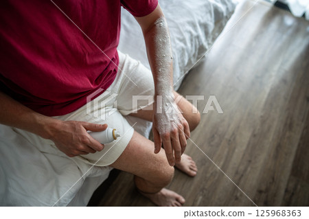 Hand in white spray after sunburn treatment. Skin soothing care, UV exposure and midday heat problem Hand in white spray after sunburn treatment. Skin soothing care, UV exposure and midday heat problem 125968363