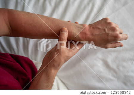 Sunburned hand show red skin pale watch mark, no skin protection. Irritation, overexposure in summer Sunburned hand show red skin pale watch mark, no skin protection. Irritation, overexposure in summer 125968542