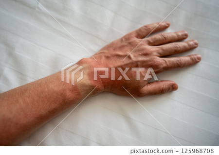 Man sunburned hand on bedsheet, red skin pale watch mark. Sun allergy irritation, UV burning pain 125968708