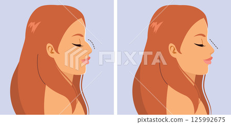 Rinhoplasty Cartoon Illustration Of Woman Nose Profile Rinhoplasty Cartoon Illustration Of Woman Nose Profile 125992675