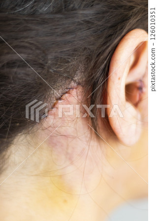 Shot of the stitches and scars on woman head after cosmetic surgery. 126010351