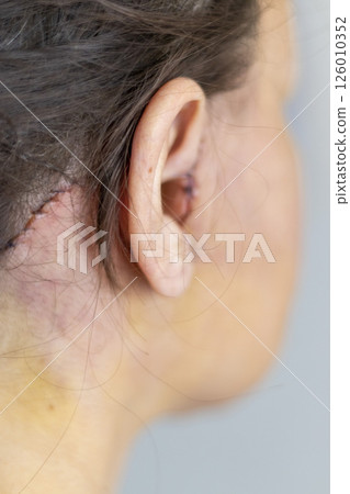 Shot of the stitches and scars on woman head after cosmetic surgery. 126010352