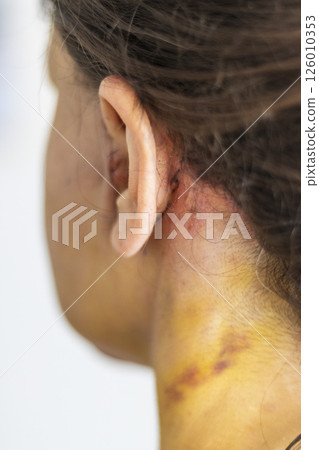 Shot of the stitches and scars on woman head after cosmetic surgery. 126010353