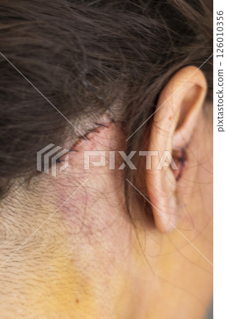 Shot of the stitches and scars on woman head after cosmetic surgery. Shot of the stitches and scars on woman head after cosmetic surgery. 126010356
