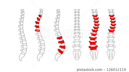 Scoliosis medical poster 126012119
