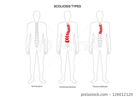 Scoliosis medical poster 126012120