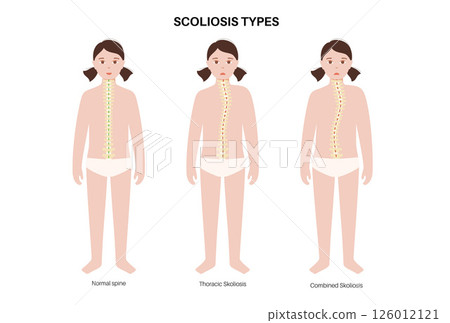 Scoliosis medical poster Scoliosis medical poster 126012121