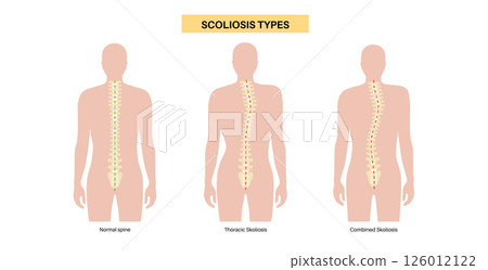 Scoliosis medical poster 126012122