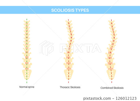 Scoliosis medical poster 126012123