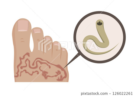 Hookworm causing cutaneous larva migrans infection in human foot 126022261