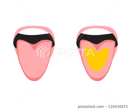 Healthy vs Yellow Coated Tongue Infographic Comparison Cartoon Vector Illustration 126030872