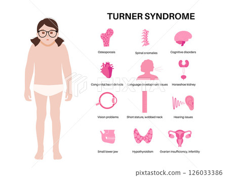 Turner syndrome poster 126033386