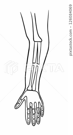 Vector isolated illustration of a closed forearm fracture. Outline drawing of a hand fracture. X-ray of the hand. 126084069