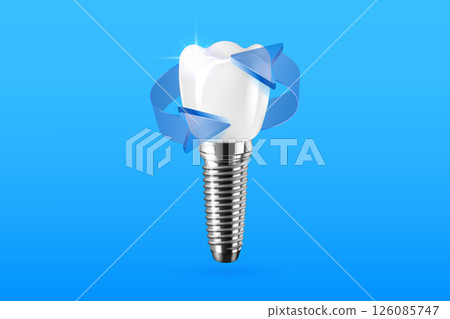 Realistic 3D dental implantation composition with blue arrows. Dental activity illustration. 126085747