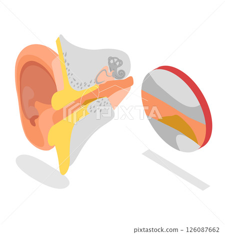 3D Isometric Flat  Illustration of Earwax Blockage, Blocked Ear Canal Due To Excess Ear Wax Buildup 126087662
