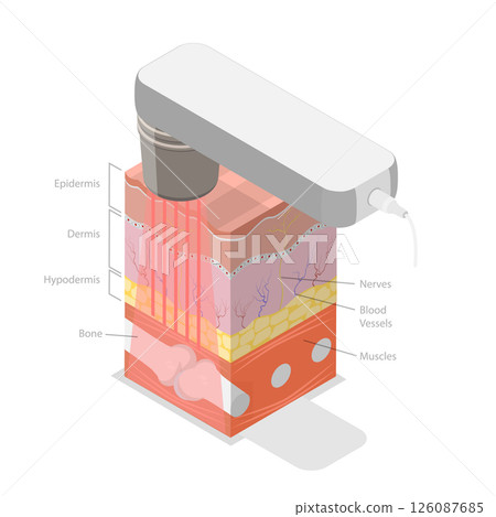 3D Isometric Flat Illustration of Laser Therapy, Alleviating Patient Pain And Stimulate Healing 3D Isometric Flat Illustration of Laser Therapy, Alleviating Patient Pain And Stimulate Healing 126087685