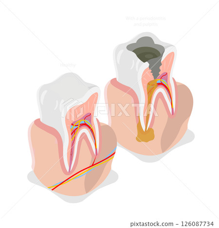 3D Isometric Flat  Illustration of Tooth Issues, Dentistry and Dental Care 126087734