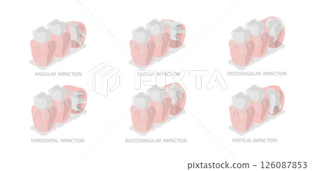 3D Isometric Flat  Illustration of Wisdoms Teeth Dental Problem, Orthodontic and Dentistry 126087853