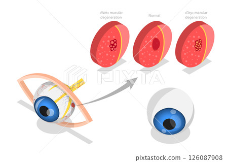 3D Isometric Flat  Illustration of Age-related Macular Degeneration, Eye Illness, Sight Problem 126087908