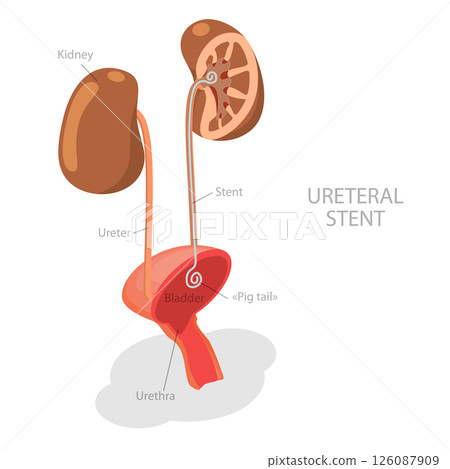 3D Isometric Flat  Illustration of Ureteral Stent, Treatment For Kidney Stones 126087909