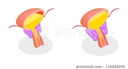 3D Isometric Flat Illustration of Enlarged Prostate Gland, Benign Prostatic Hyperplasia 3D Isometric Flat Illustration of Enlarged Prostate Gland, Benign Prostatic Hyperplasia 126088040