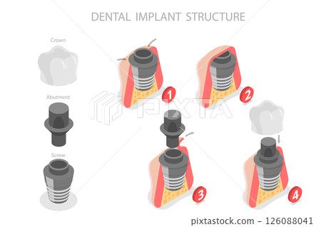 3D Isometric Flat Illustration of Dental Implant Structure, Key Components And Functionality 3D Isometric Flat Illustration of Dental Implant Structure, Key Components And Functionality 126088041