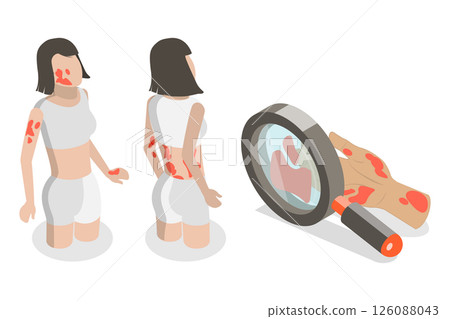 3D Isometric Flat Illustration of Atopic Dermatitis, Person With Eczema Scratches Itchy Skin 3D Isometric Flat Illustration of Atopic Dermatitis, Person With Eczema Scratches Itchy Skin 126088043