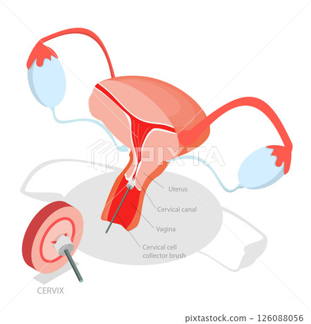 3D Isometric Flat Illustration of Pap Test, Process Of Conducting A Pap Testing To Detect Abnormal Cells In The Cervix 3D Isometric Flat Illustration of Pap Test, Process Of Conducting A Pap Testing To Detect Abnormal Cells In The Cervix 126088056