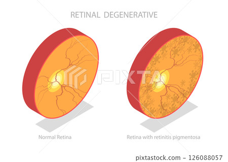 3D Isometric Flat  Illustration of Retinal Degenerative , Vision Impairment, Blind Spots 126088057