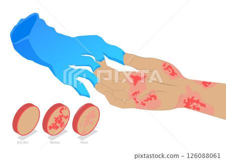 3D Isometric Flat  Illustration of Latex Allergy, Skin Reactions From Chemical Exposure 126088061
