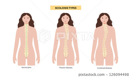 Scoliosis medical poster 126094498
