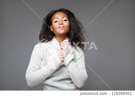 Young woman with vitiligo in white turtleneck 126096401