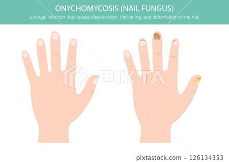 Onychomycosis Toenail Fungal Infection Vector Illustration 126134353