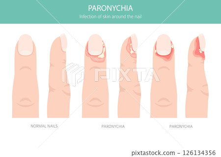 Paronychia Nail Infection.  Medical Infographic Vector Illustration 126134356